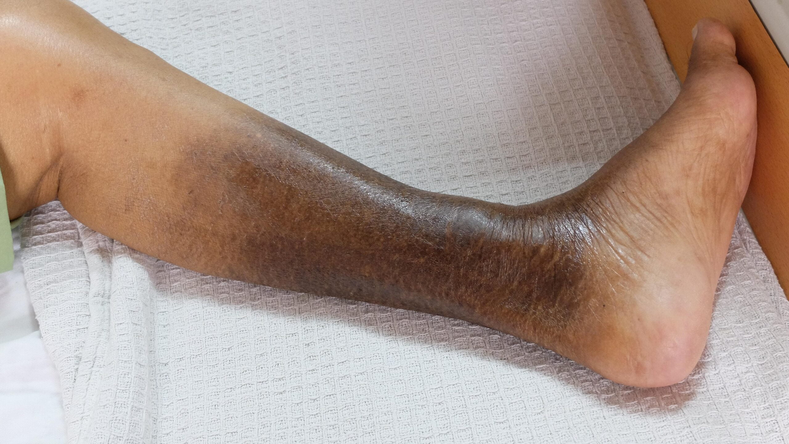 High Cholesterol May Be Affecting Your Legs – Rededit Magazine